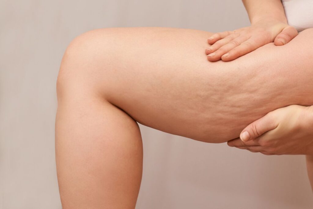 Cellulite Cest Quoi